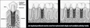 Johnson Dentistry Implants